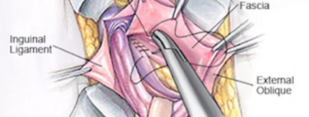 Some common types of non-mesh hernia repair techniques include