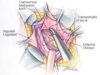 Some common types of non-mesh hernia repair techniques include