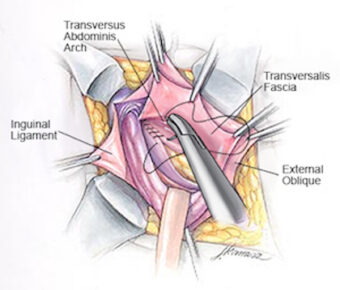Some common types of non-mesh hernia repair techniques include